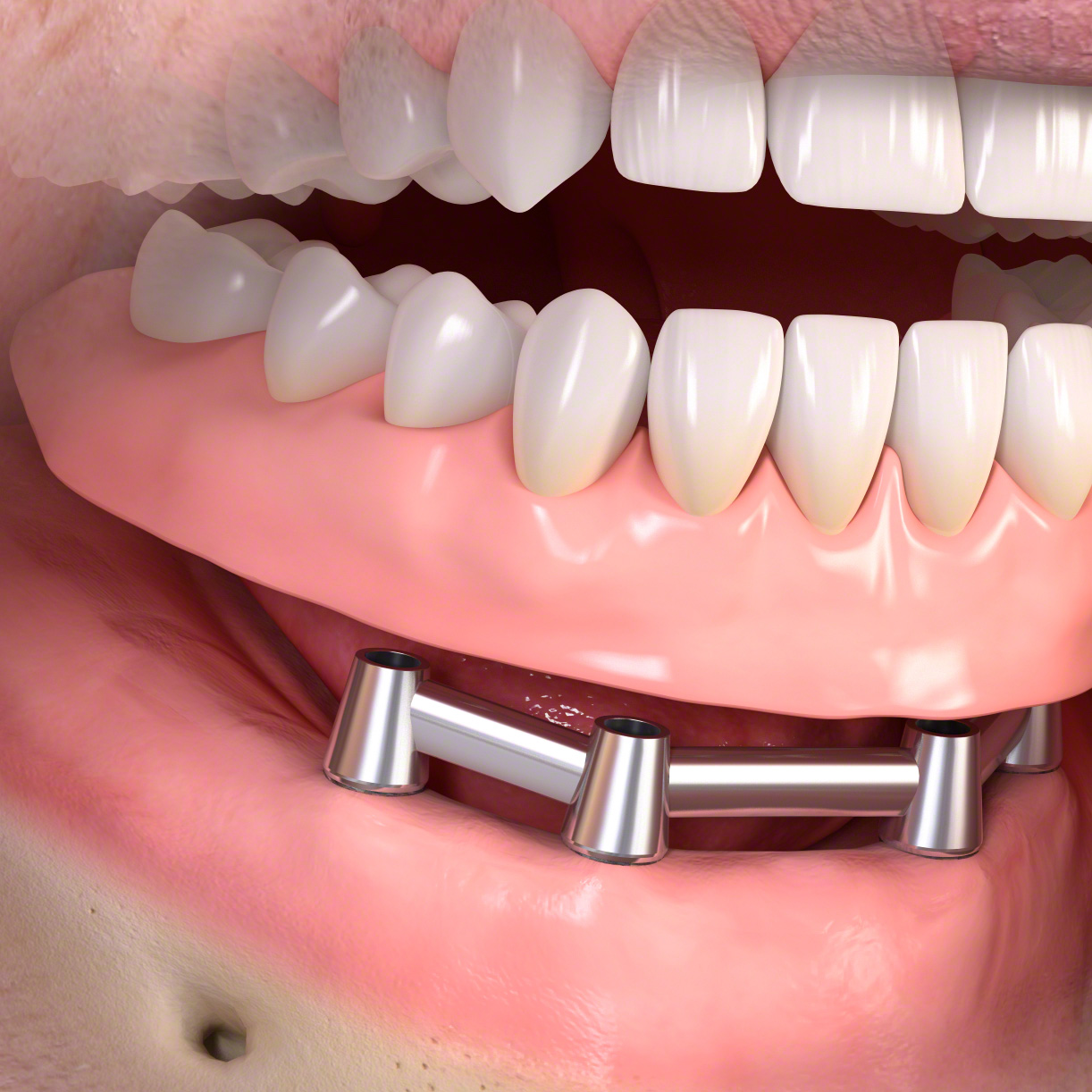 Klikgebit implantaten Almere