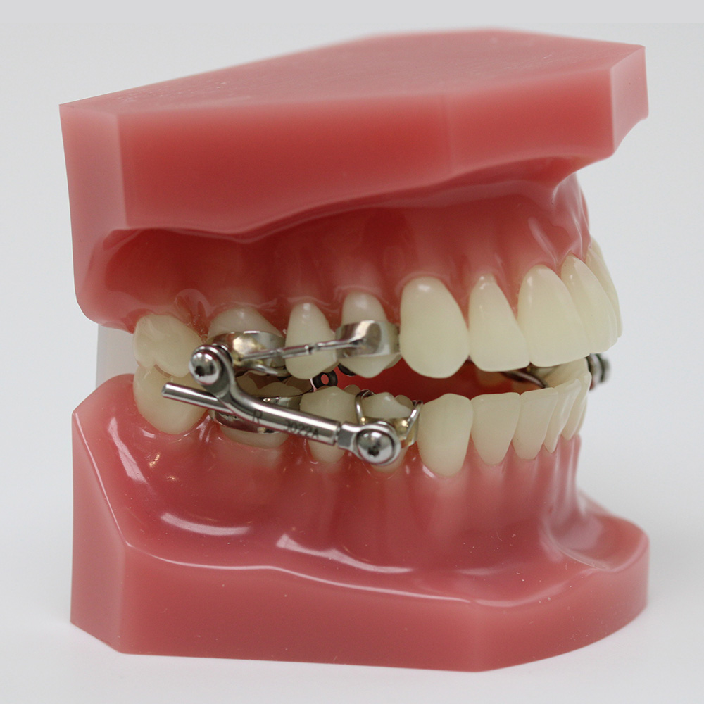 Orthodontie beugelbehandeling Almere